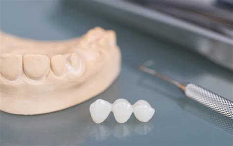 Dental Bridge Application in Ashford .